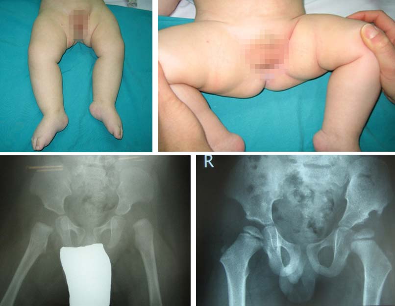Κλινική εικόνα εξαρθρήματος αριστερού ισχίου με βράχυνση και περιορισμό απαγωγής σε αγόρι. Ακτινολογική εικόνα και εικόνα μετά την ανοικτή ανάταξη με συνοδό οστεοτομία πυέλου.